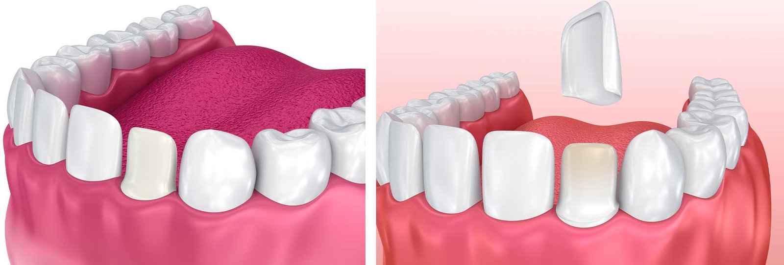 Dental Veneers